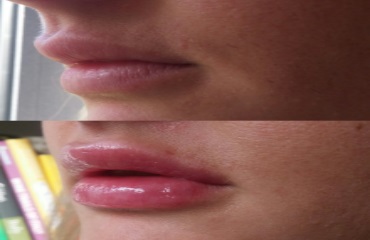 Botox and lips Wirral UK